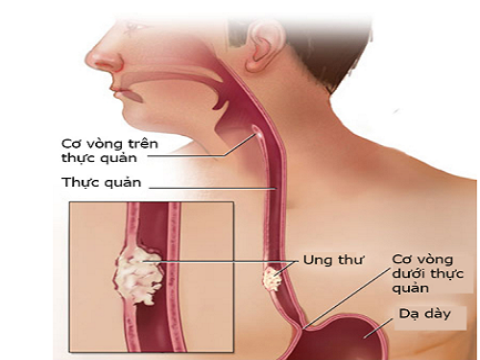 U khoảng bên họng: Báo cáo ca lâm sàng và hồi cứu y văn