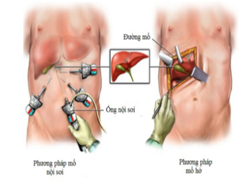 Lâm sàng và cận lâm sàng trước phẫu thuật nội soi viêm túi mật cấp do sỏi ở người cao tuổi tại Bệnh viện đa khoa thành phố Cần Thơ