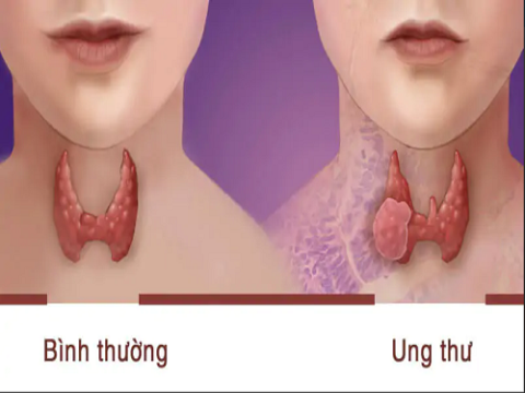 Nghiên cứu giá trị siêu âm đàn hồi giáp trong chẩn đoán ung thư giáp thể nhú