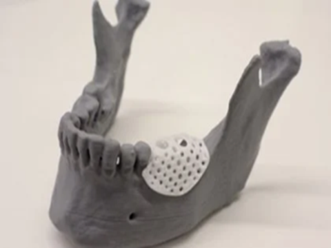 UQ sản xuất giàn giáo in 3D để tái tạo xương hàm