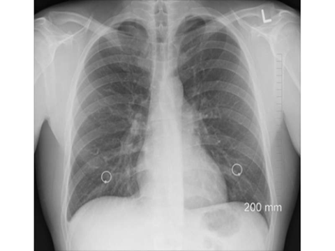 Xem xét chẩn đoán COPD để cải thiện độ chính xác và phát hiện sớm