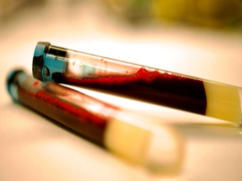 Dấu hiệu sớm của bệnh Parkinson có thể được phát hiện qua xét nghiệm máu