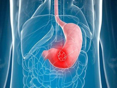 ình hình và kết quả điều trị nhiễm Helicobacter pylori trên bệnh nhân thủng dạ dày – tá tràng được phẫu thuật nội soi khâu lỗ thủng 