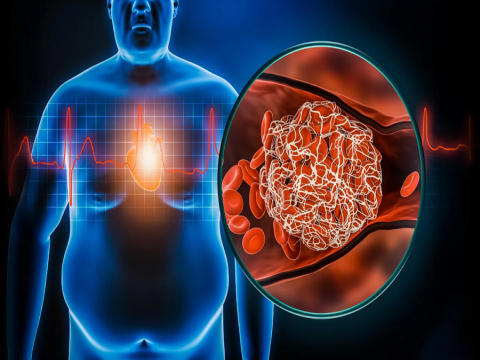 Nam giới và phụ nữ béo phì phải đối mặt với những rủi ro sức khỏe tiềm ẩn rất khác nhau