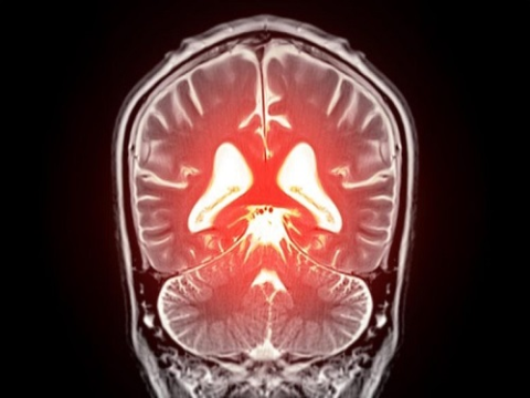 AI có thể phát hiện sớm các dấu hiệu của bệnh Alzheimer trong vòng chưa đầy một phút - trước các thử nghiệm truyền thống
