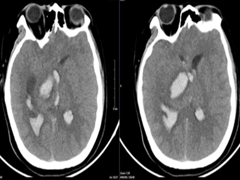 Kết quả điều trị phẫu thuật dị dạng động tĩnh mạch não hố sau vỡ tại bệnh viện Bạch Mai