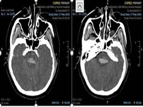 Kết quả điều trị mở sọ giảm áp ở người bệnh nhồi máu não diện rộng tại trung tâm đột quỵ tỉnh Phú Thọ